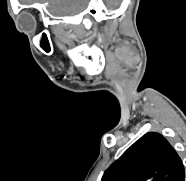 Nasopharyngeal carcinoma with skull base invasion (Radiopaedia 53415-59705 C 59).jpg