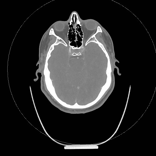 Neck CT angiogram (intraosseous vascular access) (Radiopaedia 55481-61945 B 288).jpg
