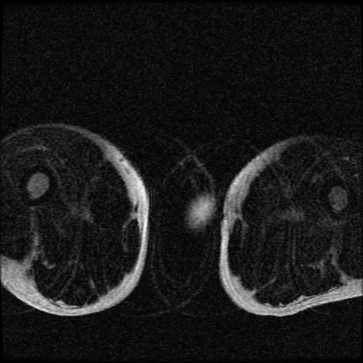 File:Necrotizing epididymo-orchitis with intra-testicular abscess (Radiopaedia 29397-29860 Axial T2 fat sat 19).jpg