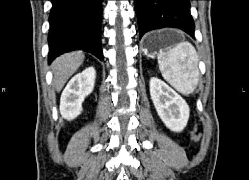Necrotizing pancreatitis (Radiopaedia 87796-104248 F 55).jpg