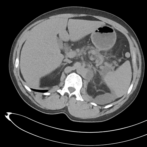 File:Necrotizing pancreatitis with acute necrotic collections (Radiopaedia 38829-41012 Axial non-contrast 26).png