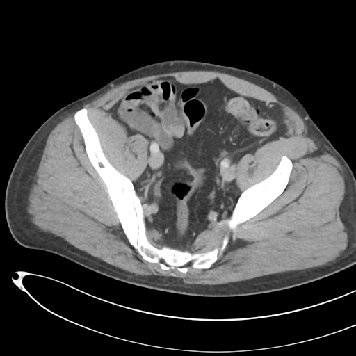 File:Necrotizing pancreatitis with acute necrotic collections (Radiopaedia 38829-41012 B 69).png