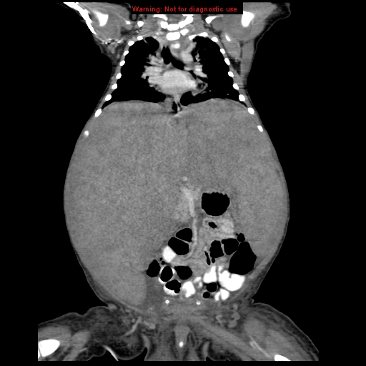 File:Neonatal neuroblastoma (Radiopaedia 9564-10223 B 68).jpg