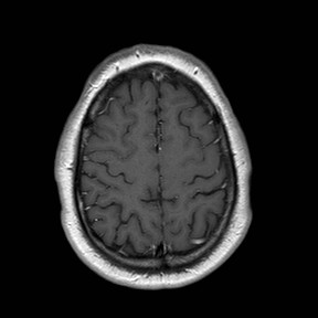 File:Neuro-Behcet's disease (Radiopaedia 21557-21506 Axial T1 C+ 23).jpg