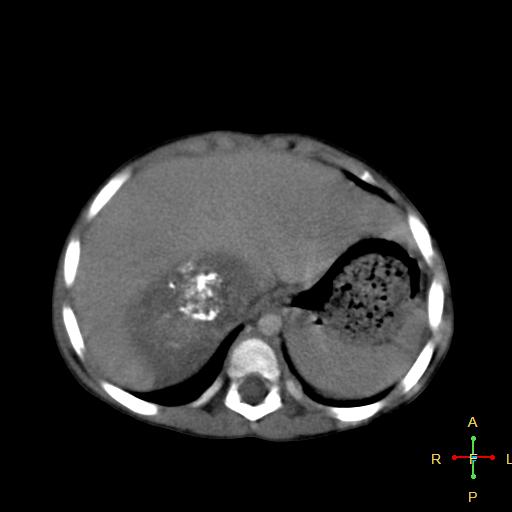 File:Neuroblastoma (Radiopaedia 24751-25016 D 5).jpg