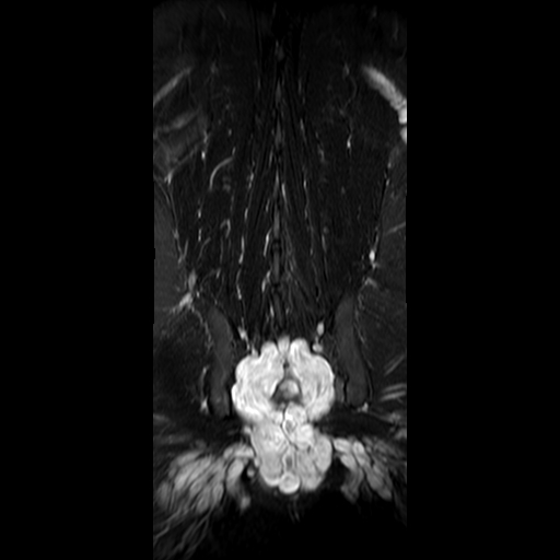 File:Neurofibromatosis type 1- extensive spinal involvement and Christmas tree sign (Radiopaedia 60610-68332 Coronal STIR 15).jpg