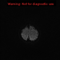File:Neurofibromatosis type 1 with optic nerve glioma (Radiopaedia 16288-15965 Axial DWI 50).jpg