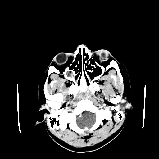 File:Neurofibromatosis type 2 (Radiopaedia 25389-25637 Axial C+ 6).jpg