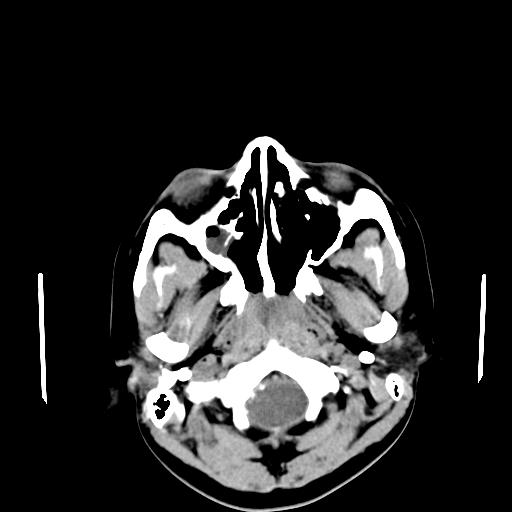File:Neurofibromatosis type 2 (Radiopaedia 25389-25637 Axial non-contrast 1).jpg