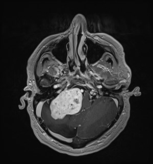 Neurofibromatosis type 2 (Radiopaedia 79097-92049 Axial T1 C+ 51).jpg