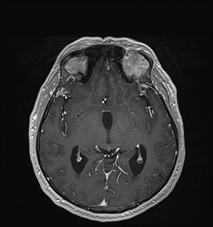Neurofibromatosis type 2 (Radiopaedia 79097-92049 Axial T1 C+ 96).jpg