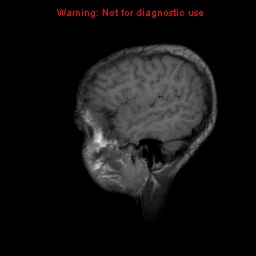 File:Neurofibromatosis type 2 (Radiopaedia 8953-9730 Sagittal T1 3).jpg
