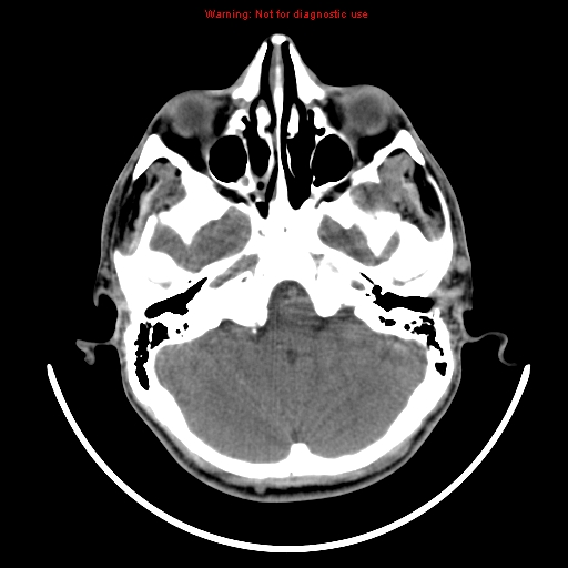 File:Neurofibromatosis type 2 (Radiopaedia 8953-9732 Axial non-contrast 6).jpg