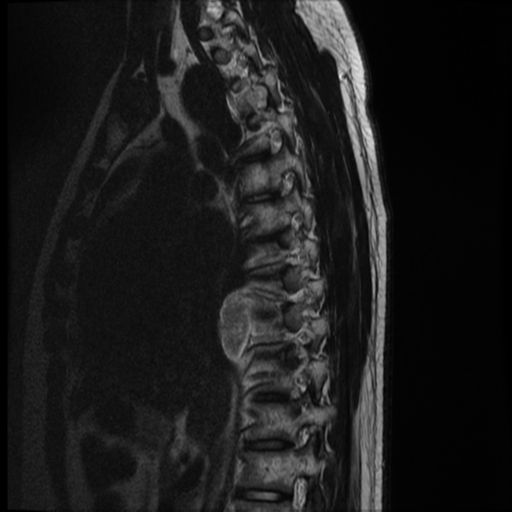 File:Neurofibromatosis type 2 (spinal manifestations) (Radiopaedia 53943-60070 C 11).png