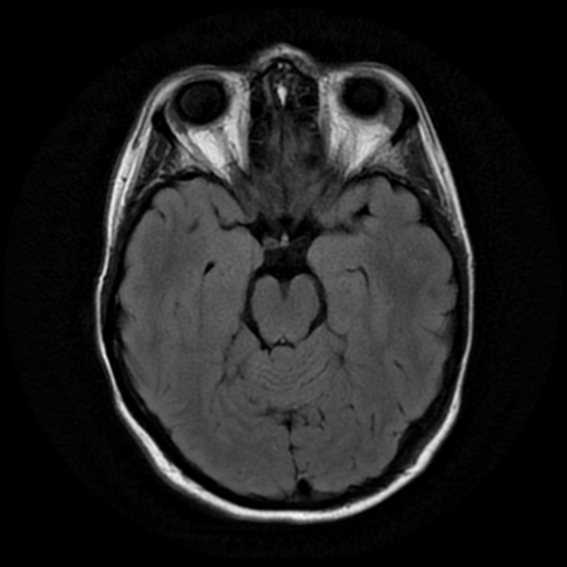 File:Neurofibromatosis type 2 - bilateral acoustic neuromata (Radiopaedia 40060-42566 Axial FLAIR 8).png