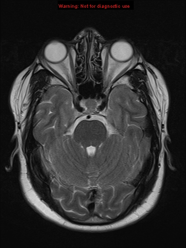 File:Neuroglial cyst (Radiopaedia 10713-11184 Axial T2 16).jpg