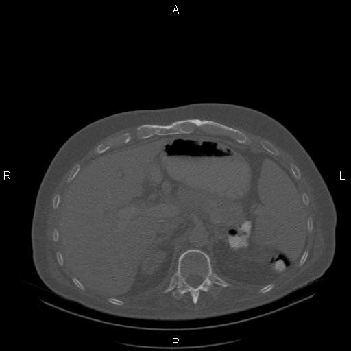 Non Hodgkin lymphoma in a patient with ankylosing spondylitis (Radiopaedia 84323-99624 Axial bone window 30).jpg