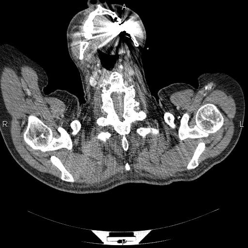 File:Non Hodgkin lymphoma in a patient with ankylosing spondylitis (Radiopaedia 84323-99624 B 1).jpg