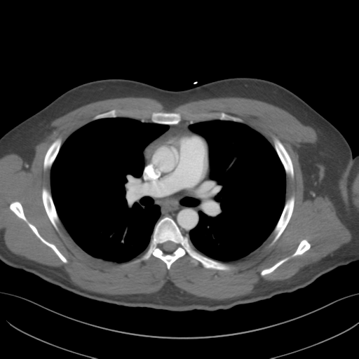 File:Normal CTA thorax (non ECG gated) (Radiopaedia 41750-44704 A 44).png