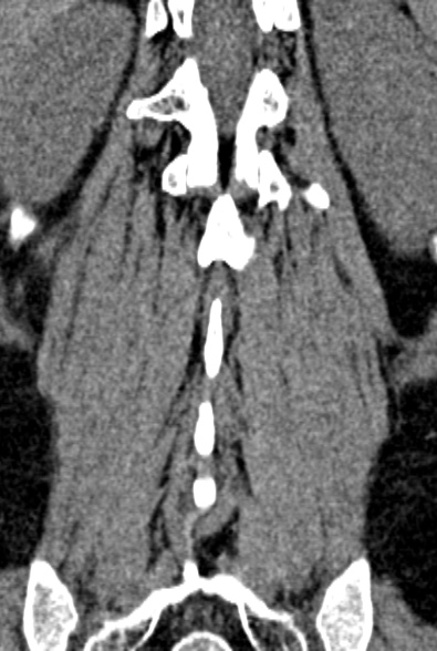 Normal CT lumbar spine (Radiopaedia 53981-60118 F 78).jpg