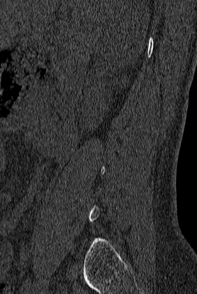 File:Normal CT lumbar spine (Radiopaedia 53981-60118 Sagittal bone window 2).jpg