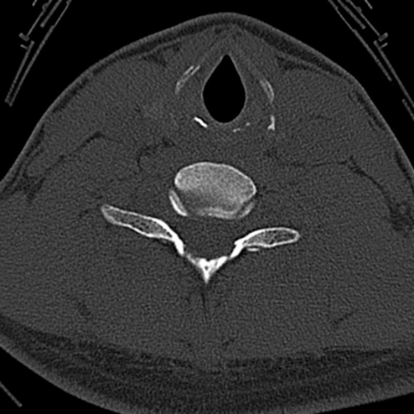 Normal CT of the cervical spine (Radiopaedia 53322-59305 Axial bone window 194).jpg