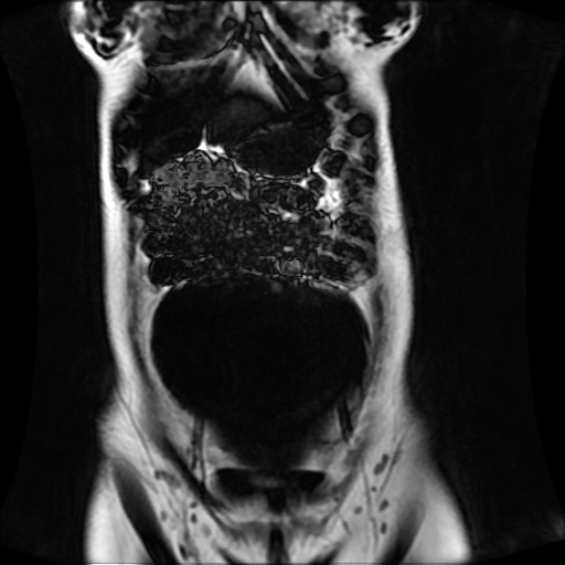 Normal MRI abdomen in pregnancy (Radiopaedia 88001-104541 N 39).jpg