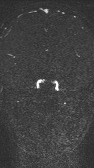 Normal MRI brain with MRV- teenager (Radiopaedia 49425-54553 Coronal MRV 123).jpg