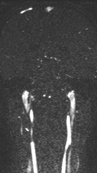 Normal MRI brain with MRV- teenager (Radiopaedia 49425-54553 Coronal MRV 149).jpg