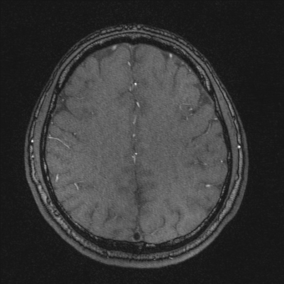 Normal brain MRI including MRA (Radiopaedia 48748-53763 Axial MRA 158).jpg