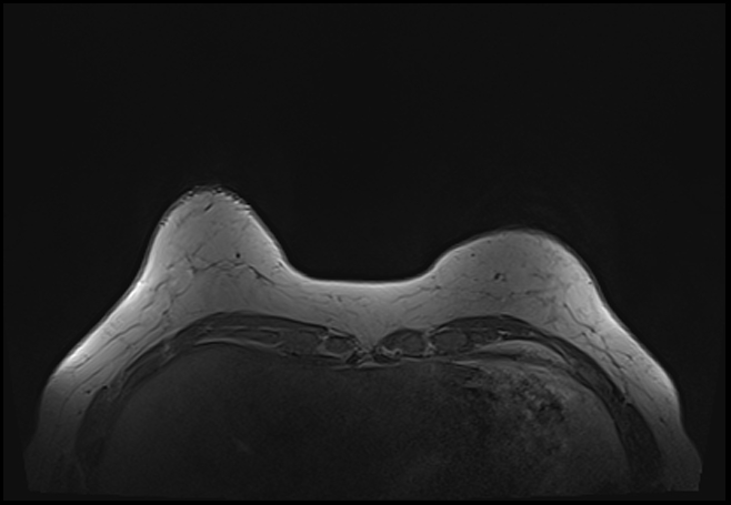 File:Normal breast MRI - dense breasts (Radiopaedia 80454-93850 Axial T1 33).jpg