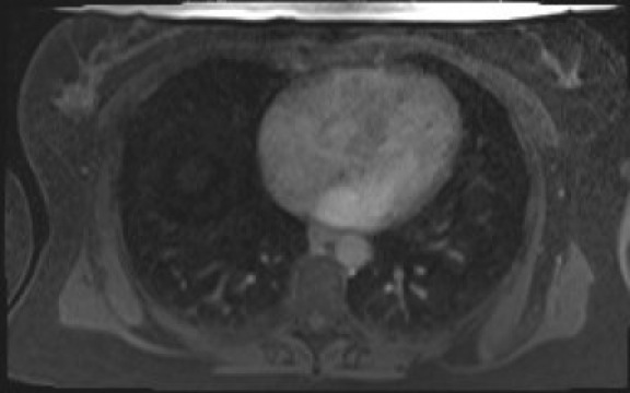 File:Normal hepatobiliary phase liver MRI (Radiopaedia 58968-66230 A 6).jpg