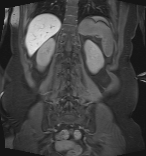 File:Normal hepatobiliary phase liver MRI (Radiopaedia 58968-66230 B 11).jpg