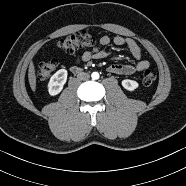 Normal kidneys on 4-phase CT study (Radiopaedia 25889-26038 B 68).jpg