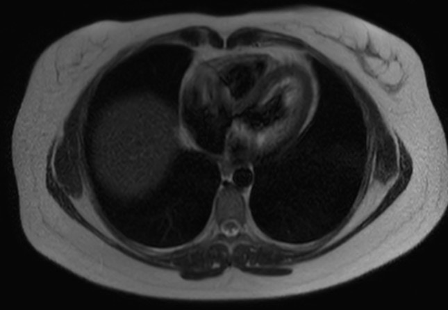 File:Normal liver MRI with Gadolinium (Radiopaedia 58913-66163 Axial T2 32).jpg