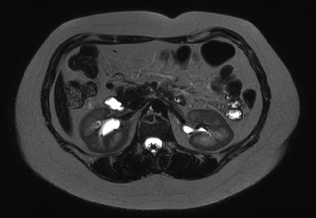 File:Normal liver MRI with Gadolinium (Radiopaedia 58913-66163 E 13).jpg