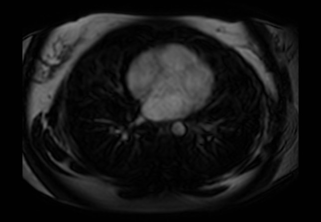 Normal liver MRI with Gadolinium (Radiopaedia 58913-66163 J 89).jpg