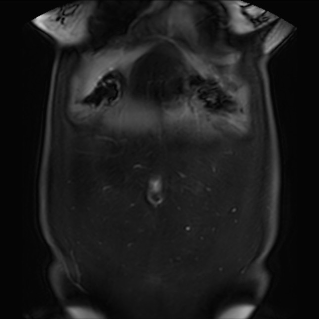 Normal liver MRI with Gadolinium (Radiopaedia 58913-66163 P 14).jpg