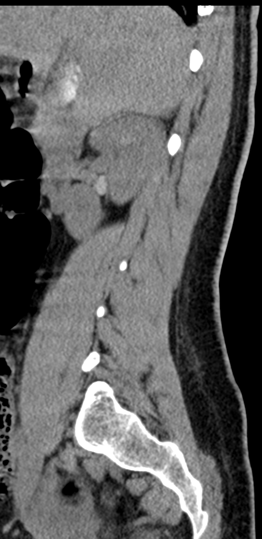 Normal lumbosacral CT (Radiopaedia 37923-39867 E 83).png