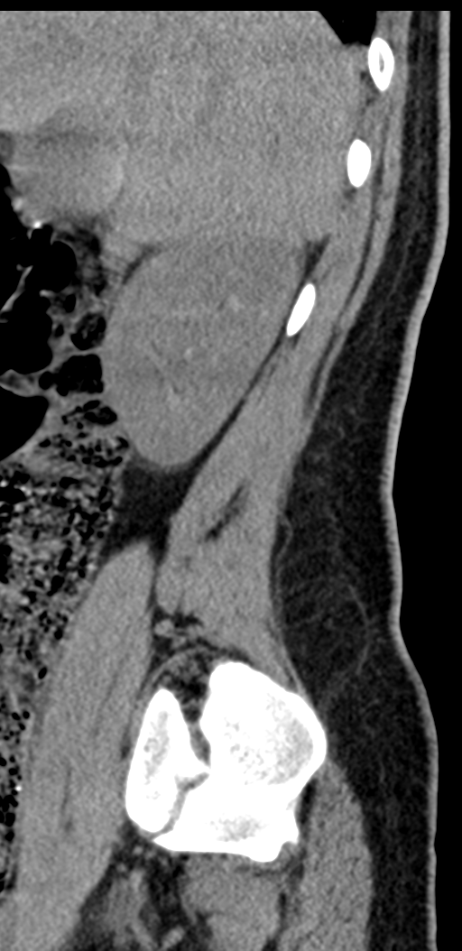 Normal lumbosacral CT (Radiopaedia 37923-39867 E 95).png