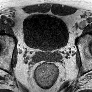 File:Normal prostate (MRI) (Radiopaedia 29986-30535 Axial T1 18).jpg