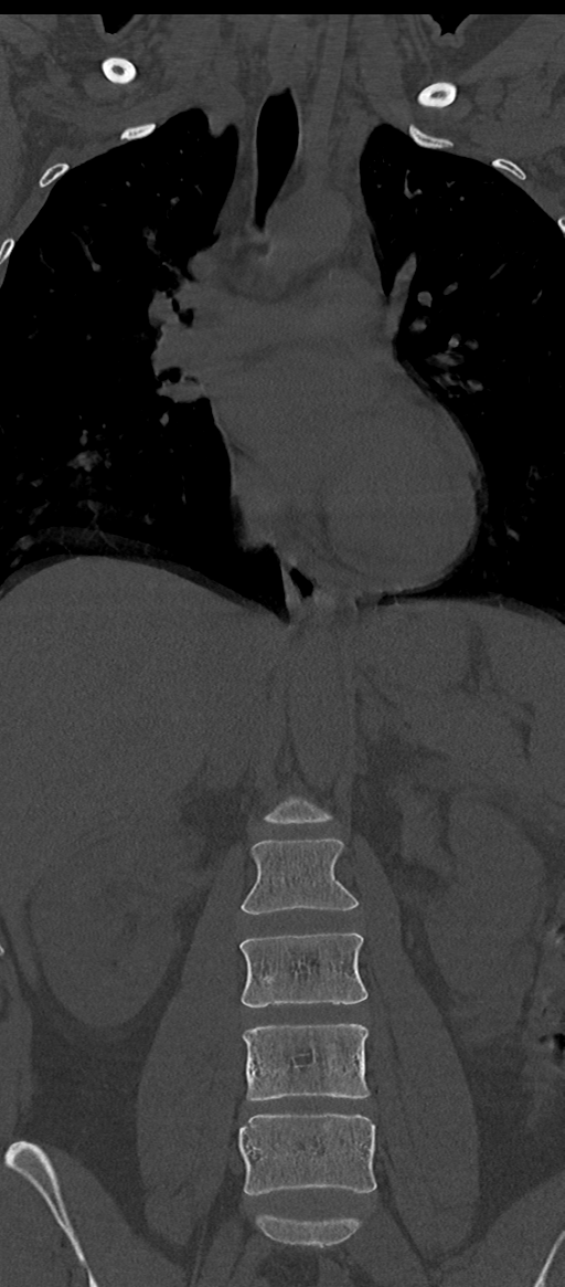 Normal thoracolumbar spine (Radiopaedia 43822-47309 Coronal bone window 34).png