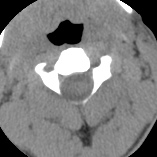 Normal trauma cervical spine (Radiopaedia 41017-43760 Axial non-contrast 20).png