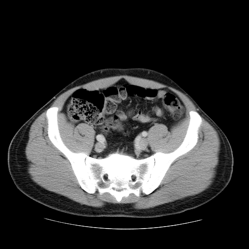File:Obstructing ureteric calculus (Radiopaedia 18615-18514 B 43).jpg