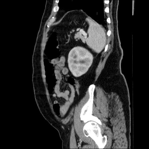 Obstructing ureteric calculus (Radiopaedia 49281-54373 C 24).jpg