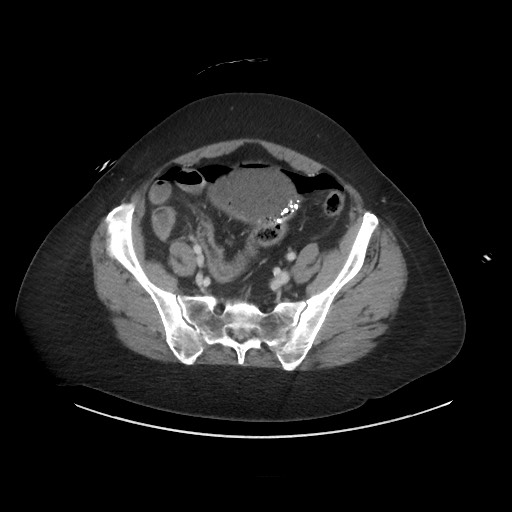Obstructive distal colonic adenocarcinoma causing cecal perforation (Radiopaedia 86830-102989 A 150).jpg