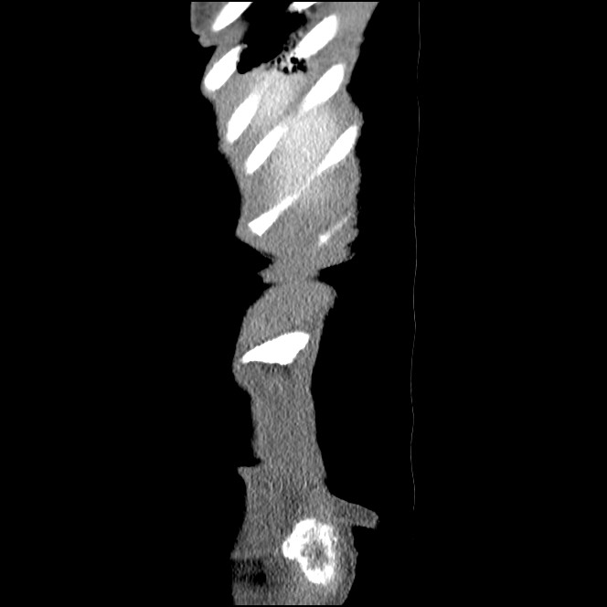 Obturator hernia causing small bowel obstruction (Radiopaedia 65522-74612 C 92).jpg