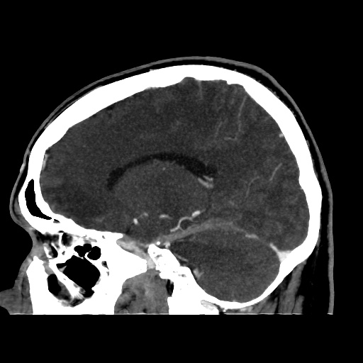 Occipital extradural hematoma simulating venous sinus thrombosis (Radiopaedia 46514-50964 D 47).jpg