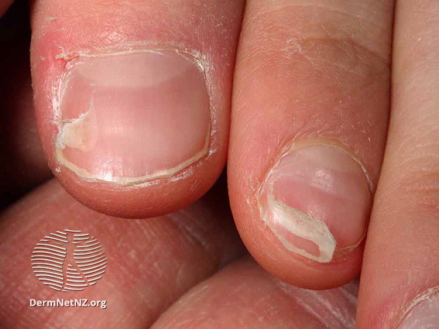 File:Onychomadesis following hand foot and mouth disease (DermNet NZ enteronail7).jpg