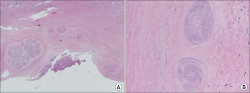 Trichinella spiralis are seen in the fibromuscular tissue of the right ventricle